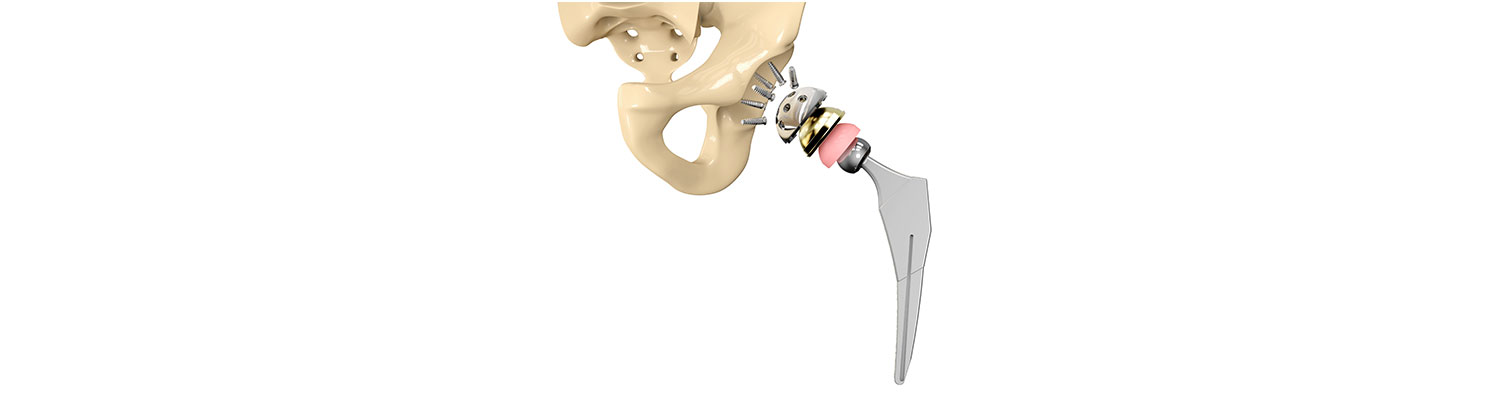 Biomet Loses In Two Separate M2a Magnum Hip Implant Trials