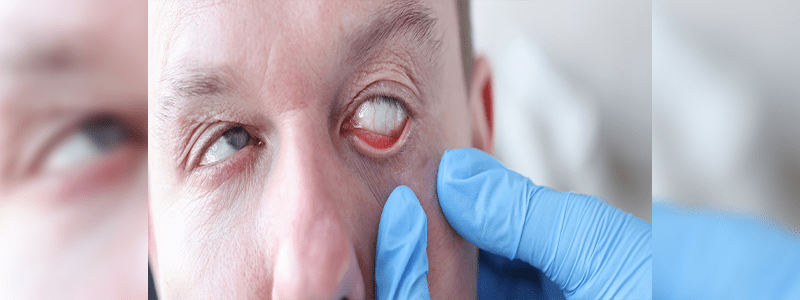 Long Term Users Of Elmiron Unaware Of Eye Damage Risks