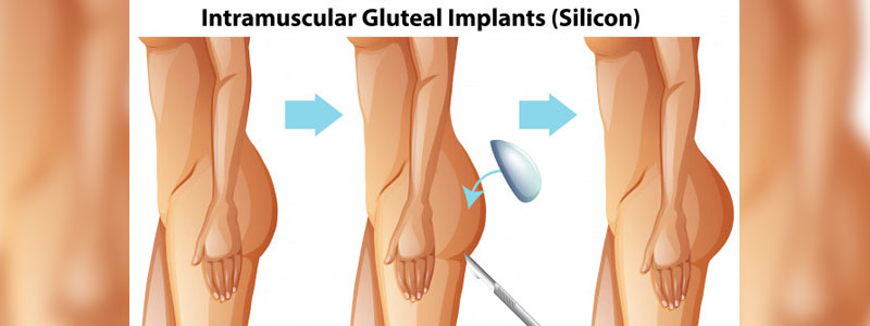 JPML To Consider Profemur Hip Implant MDL Consolidation