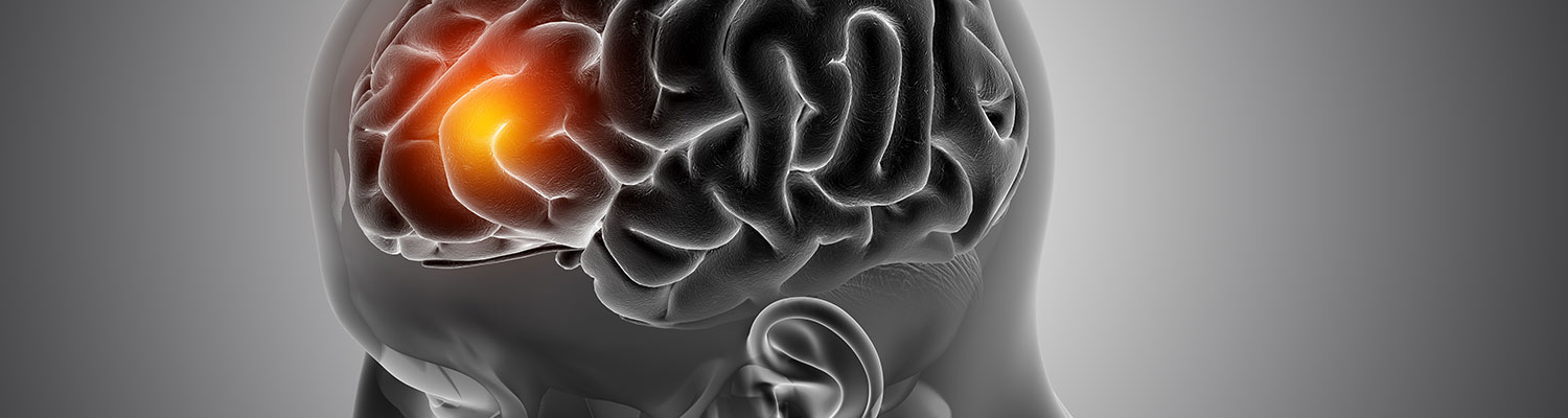 Stroke Patients Prone To Retain Gadolinium In Brain: Study