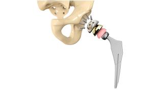 Federal Judge May Include Smith & Nephew Hip Replacement Lawsuits with Hip Resurfacing MDL