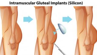 JPML To Consider Profemur Hip Implant MDL Consolidation