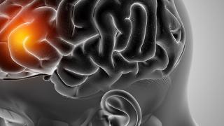 Stroke Patients Prone To Retain Gadolinium In Brain: Study